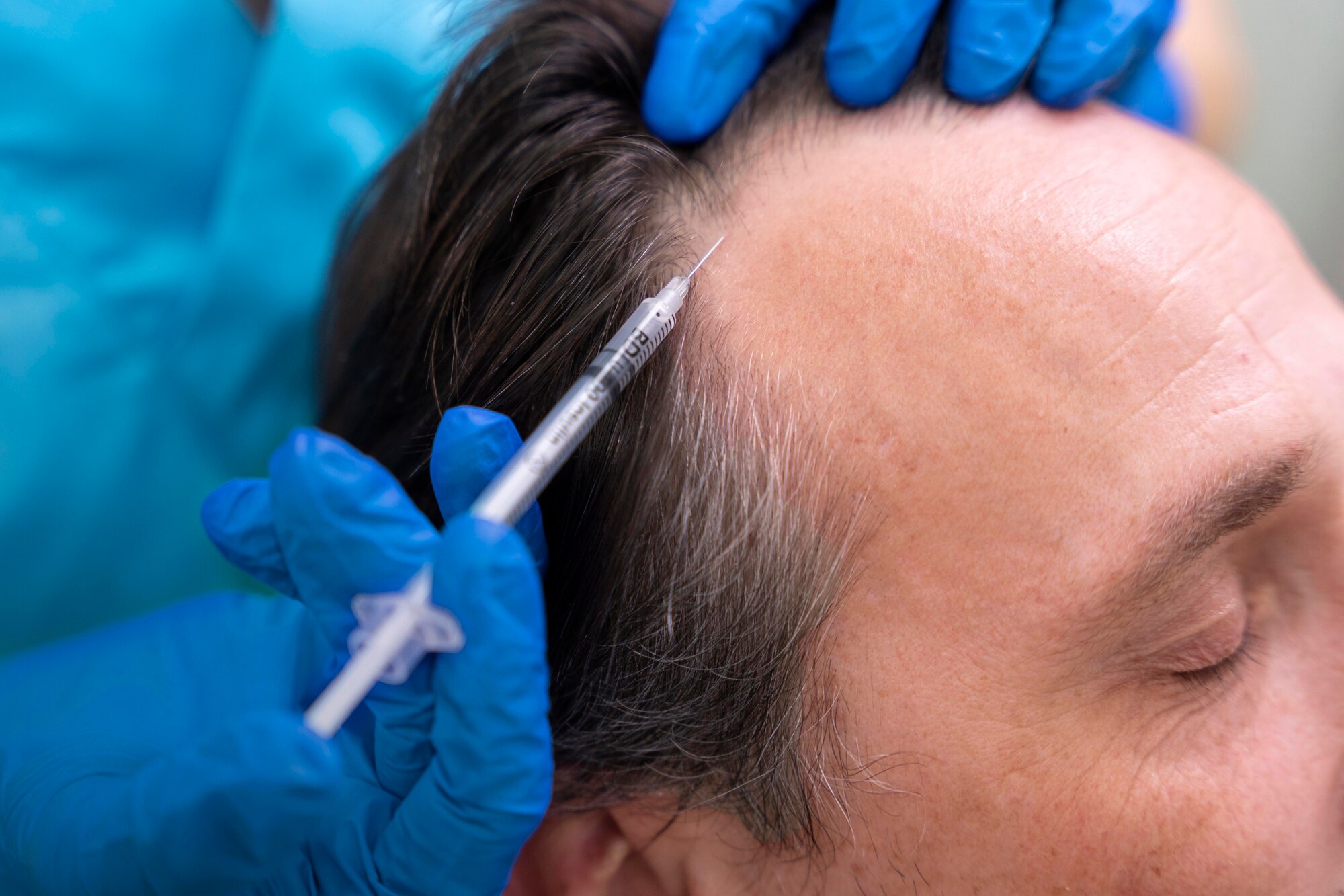 hair loss treatment درمان ریزش مو
