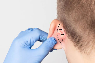 otoplasty ear اتوپلاستی گوش
