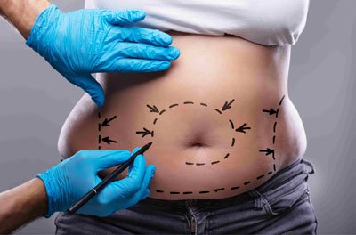 ابدومینوپلاستی abdominoplasty or tummy tuck surgery