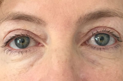 بلفاروپلاستی پلک جراحی زیبایی پلک blepharoplasty