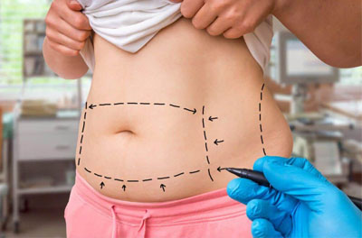 body liposuction contouring لیپوساکشن کانتورینگ بدن