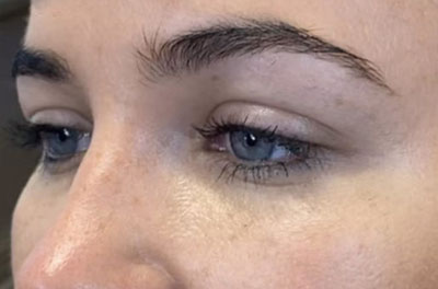 نمونه لیفت ابرو کلینیک زیبایی دکتر فرخ دادگستری eyebrow lifting before after