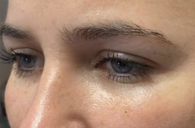 نمونه لیفت ابرو کلینیک زیبایی دکتر فرخ دادگستری eyebrow lifting before after