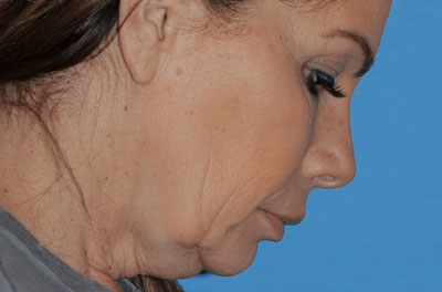 نمونه تصاویر قبل و بعد از لیفت صورت facelift rhytidectomy