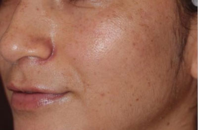 نمونه جوان سازی صورت کلینیک زیبایی دکتر فرخ دادگستری facial rejuvenation before after