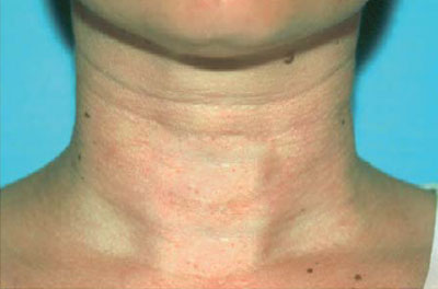 نمونه ساکشن گردن کلینیک زیبایی دکتر فرخ دادگستری neck liposuction