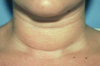 نمونه ساکشن گردن کلینیک زیبایی دکتر فرخ دادگستری neck liposuction